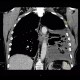 Pneumonectomy, hematoma of the pleural cavity, subcutaneous emphysema: CT - Computed tomography